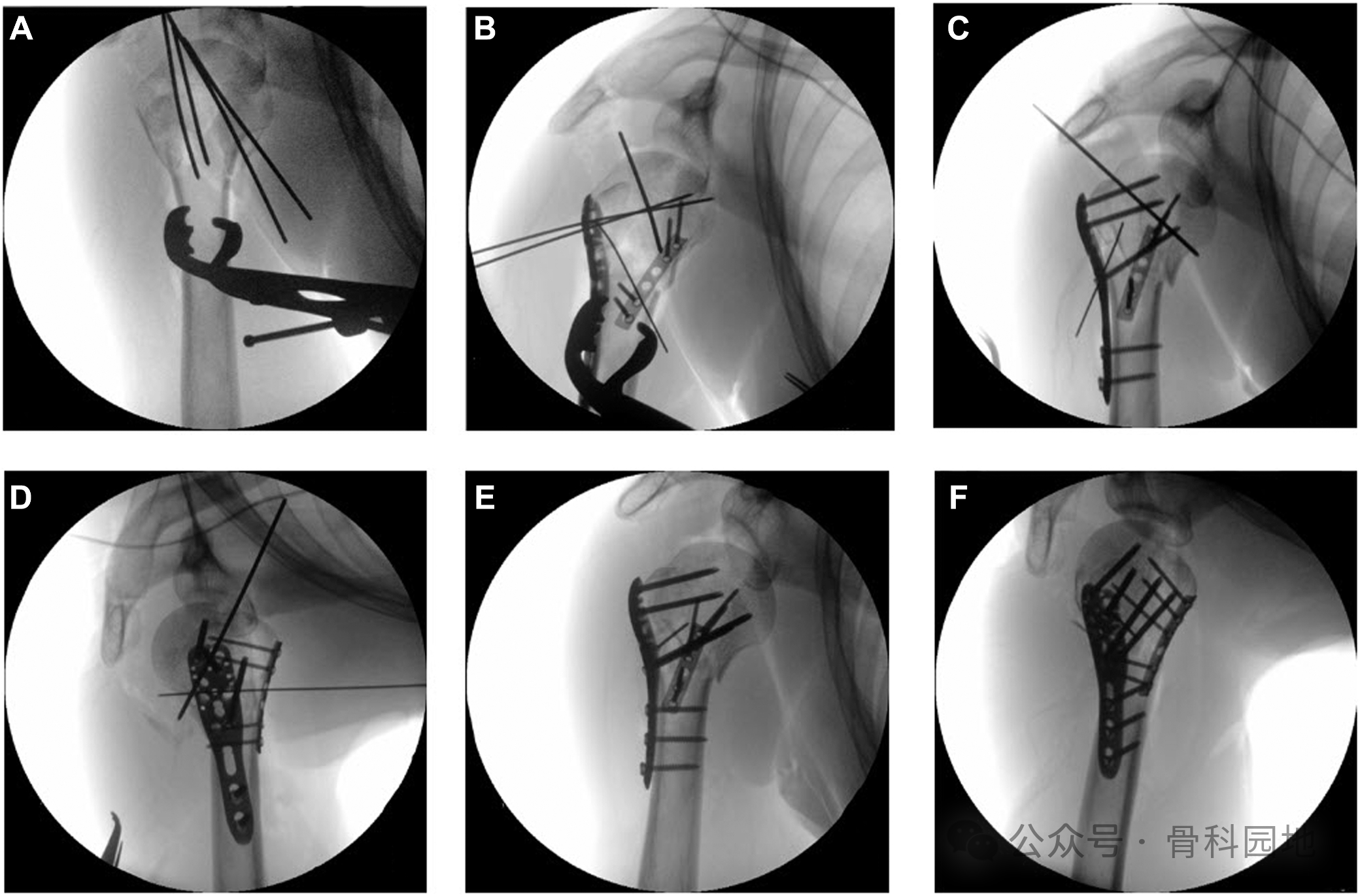 Standardized Reduction Technique in Proximal Humerus Fractures