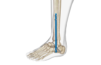 What foot and ankle products are needed for diabetic foot patients?