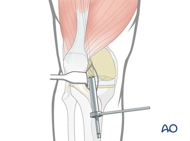 Retrograde Intramedullary Nailing for Periprosthetic Femoral Fractures After TKA: AO Standardized Surgical Strategy – Illustrated Step-by-Step Guide