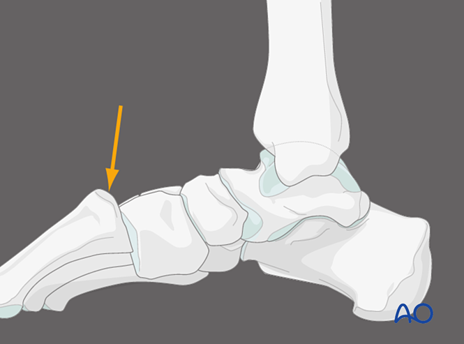 IV. Approach Preparation