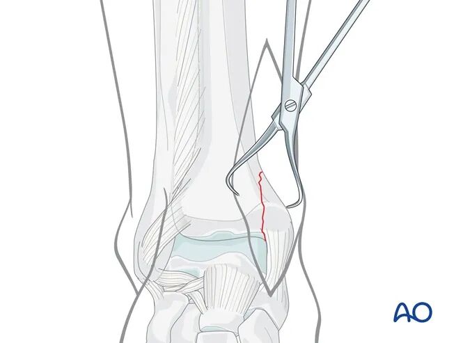 AO Standard Technique: Buttress Plate Fixation for Medial Malleolus Fractures