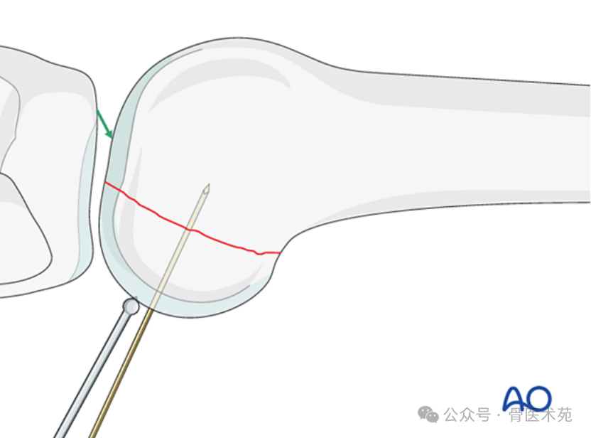 Open Reduction and Internal Fixation of Hoffa Fracture with Plate and Screws