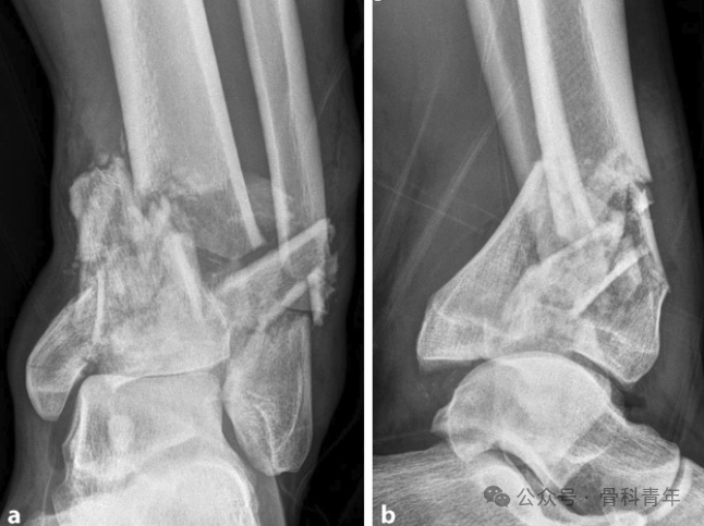 Complex Pilon Fractures: The "Four Principles" and the "Four-Step Foundation Method"