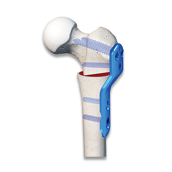 Proximal Femoral Compression locking Plate