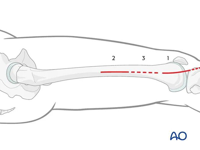 Minimally Invasive Lateral/Anterolateral MIPO Approach to the Distal Femur