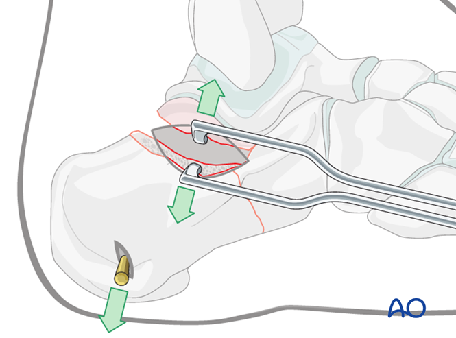 Minimally Invasive K‑Wire and Screw Fixation for Calcaneal Fractures