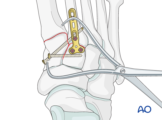 IV. Approach Preparation