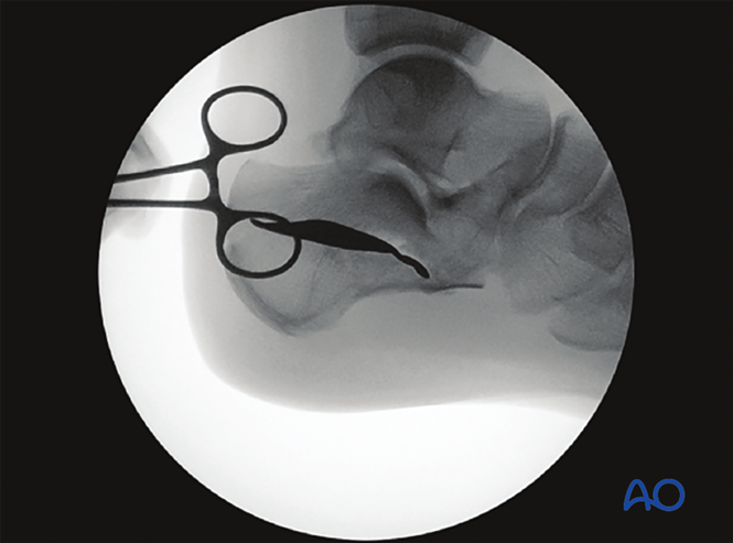 Minimally Invasive K‑Wire and Screw Fixation for Calcaneal Fractures