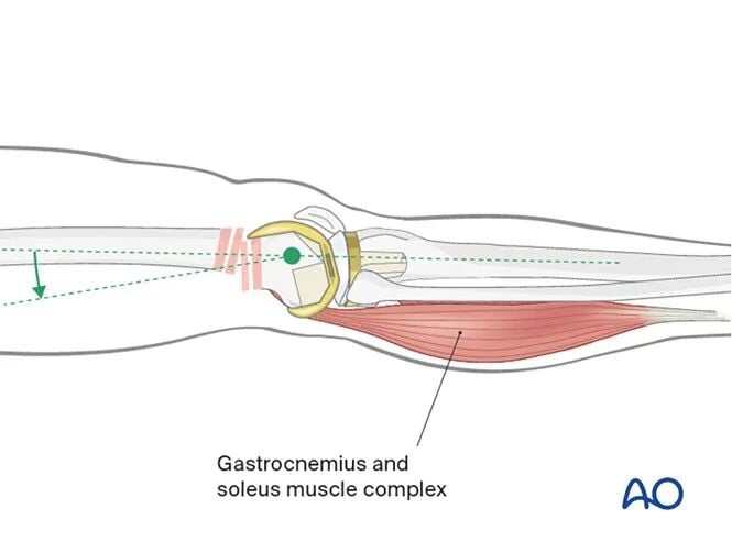 Retrograde Intramedullary Nailing for Periprosthetic Femoral Fractures After TKA: AO Standardized Surgical Strategy – Illustrated Step-by-Step Guide