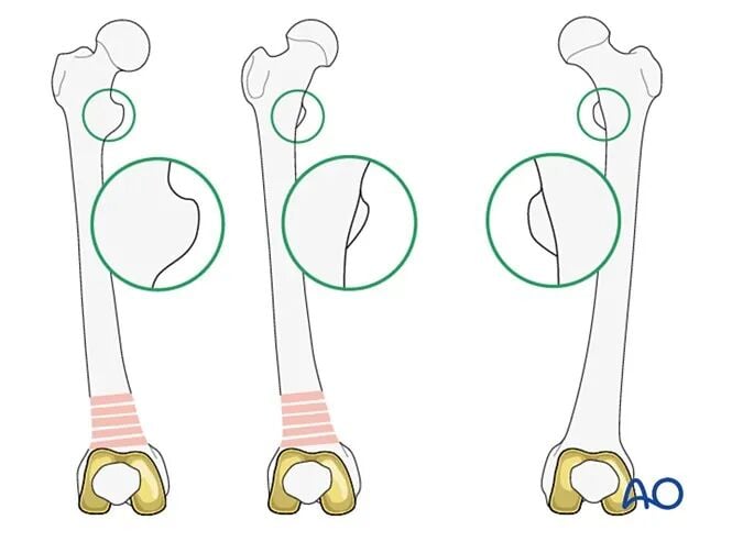 Retrograde Intramedullary Nailing for Periprosthetic Femoral Fractures After TKA: AO Standardized Surgical Strategy – Illustrated Step-by-Step Guide
