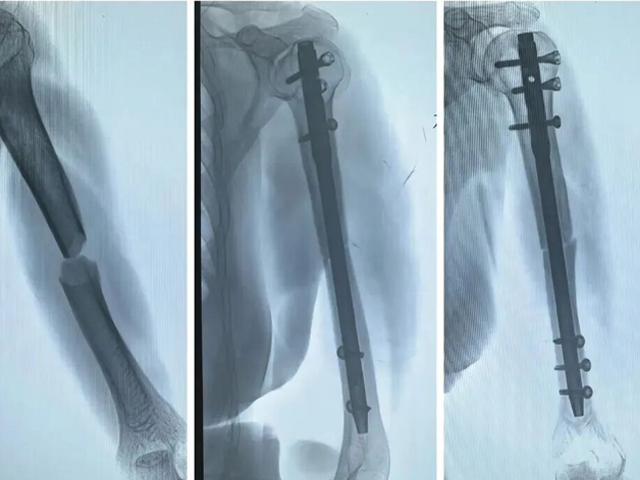 Perform humeral intramedullary nailing according to AO principles