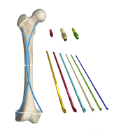 Clinical application of elastic intramedullary needle in the treatment of children