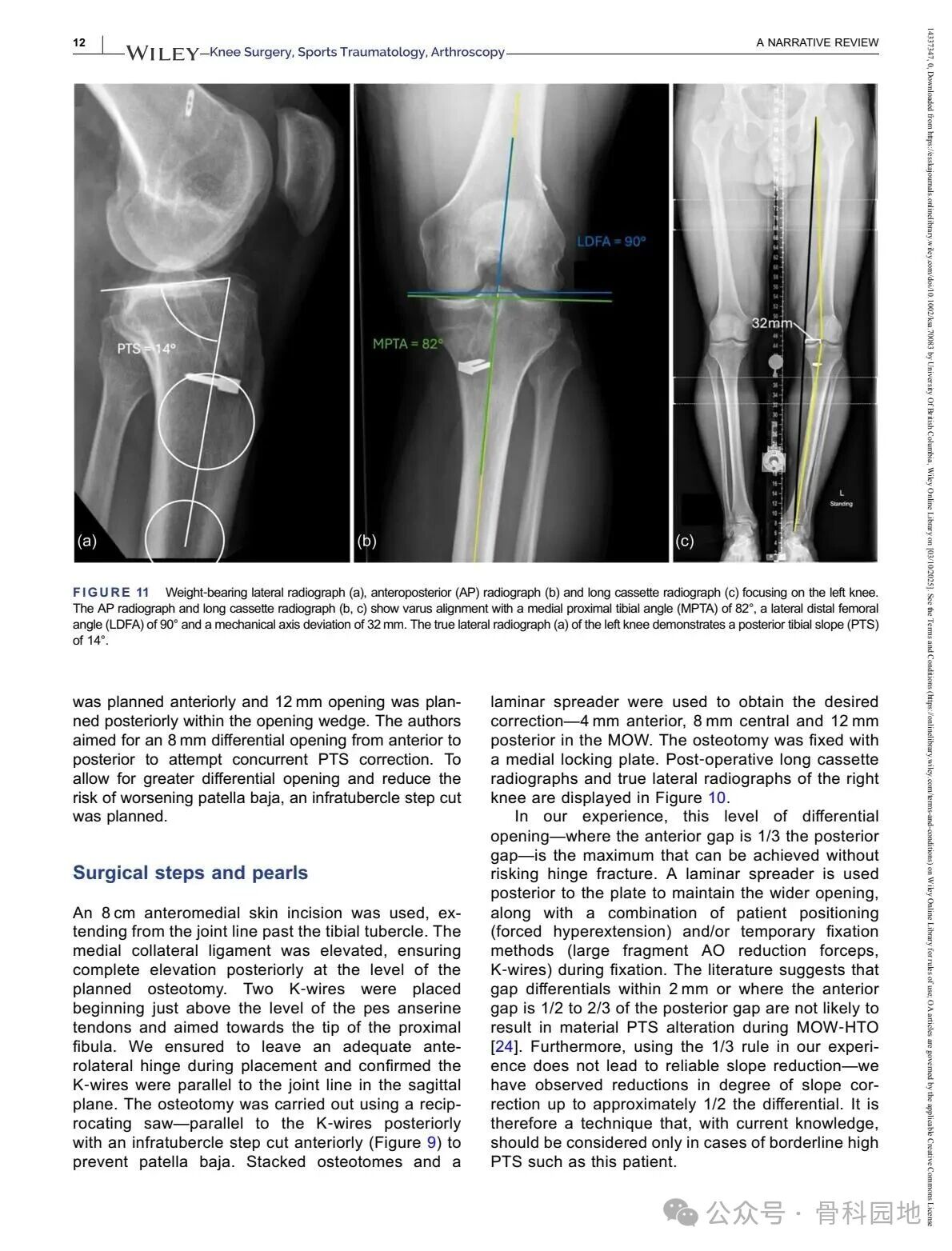 Technical Tips and Tricks for Complex Biplanar High Tibial Osteotomy