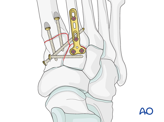 IV. Approach Preparation