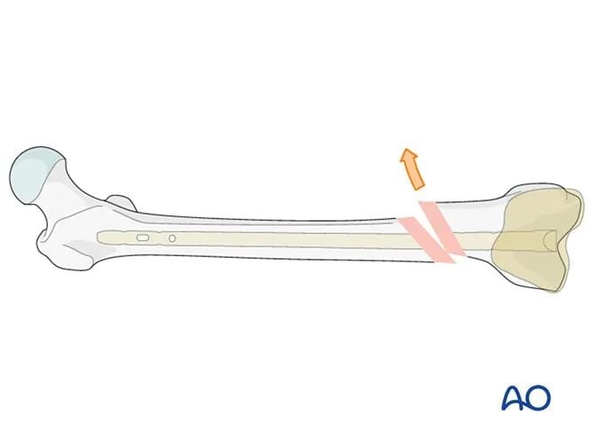 Retrograde Intramedullary Nailing for Periprosthetic Femoral Fractures After TKA: AO Standardized Surgical Strategy – Illustrated Step-by-Step Guide