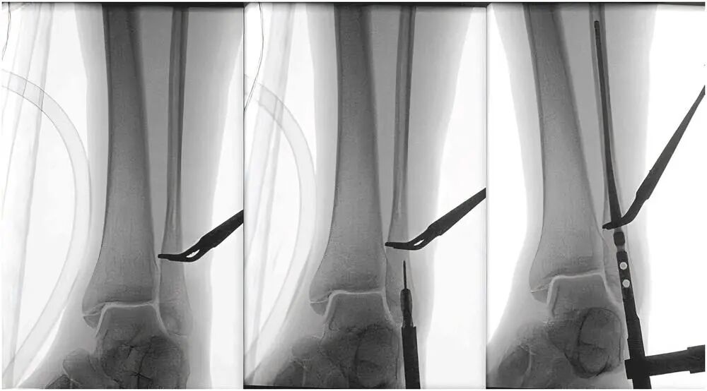 Innovative approach to intramedullary nailing of the fibula: atechnical note