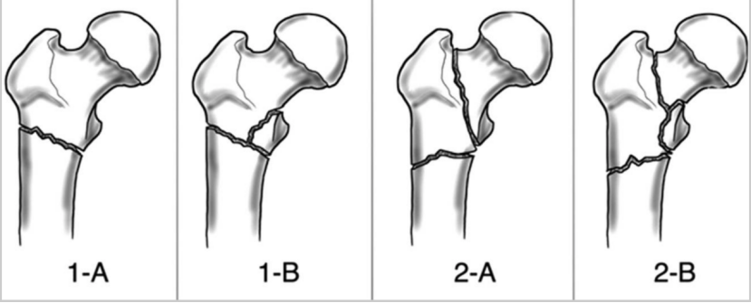 Subtrochanteric Femur Fractures: Anatomy, Classification, and Treatment Options