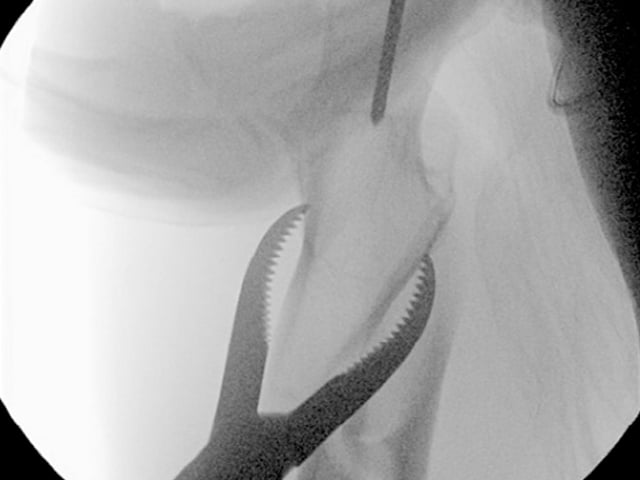 Changes in Entry Point for Intramedullary Nailing of Proximal Femoral Fractures: The Central Collinear Method