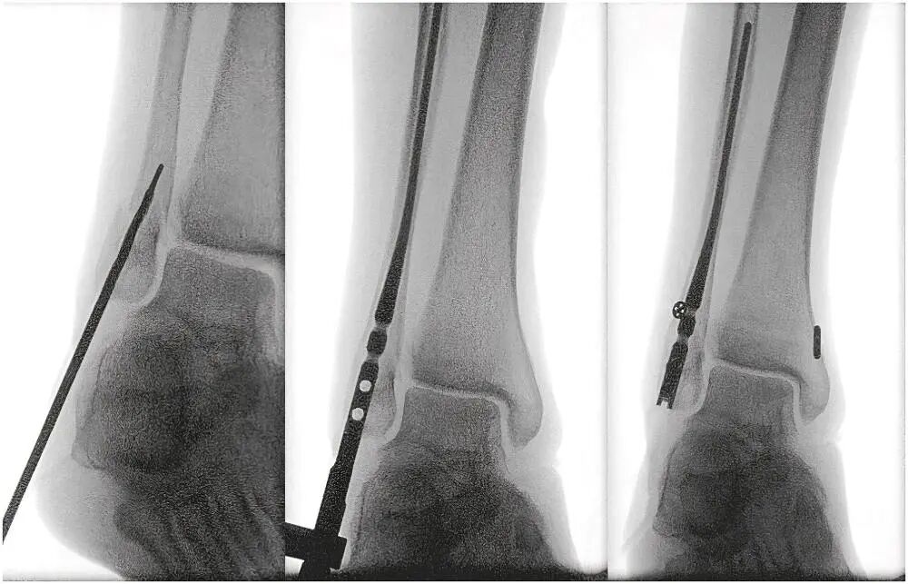 Innovative approach to intramedullary nailing of the fibula: atechnical note