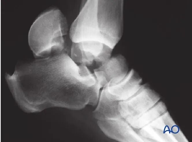 AO Standard Surgery: Screw Fixation for Displaced Talar Neck Fractures