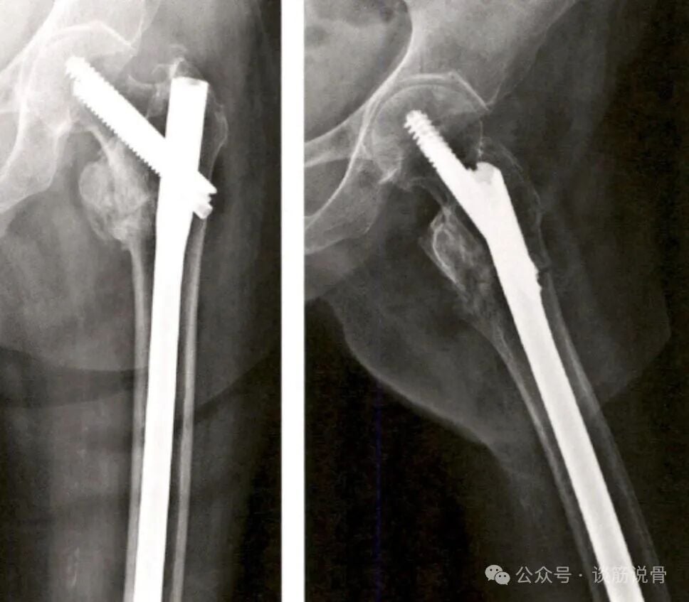 Clinical Decision-Making Between Long and Short Intramedullary Nails for Intertrochanteric Femoral Fractures