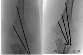 Treatment of Pediatric Supracondylar Humerus Fractures