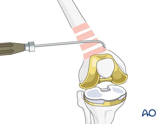 Retrograde Intramedullary Nailing for Periprosthetic Femoral Fractures After TKA: AO Standardized Surgical Strategy – Illustrated Step-by-Step Guide
