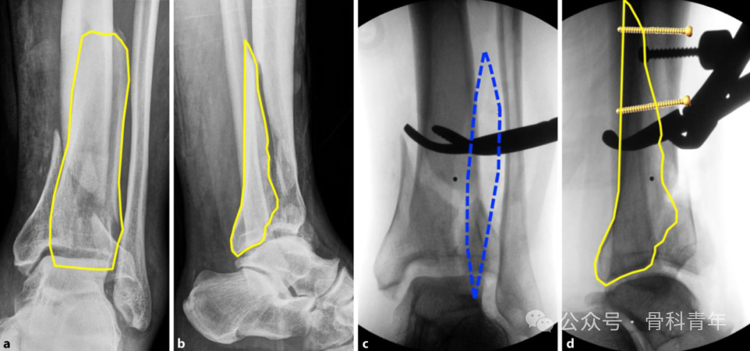 Complex Pilon Fractures: The "Four Principles" and the "Four-Step Foundation Method"