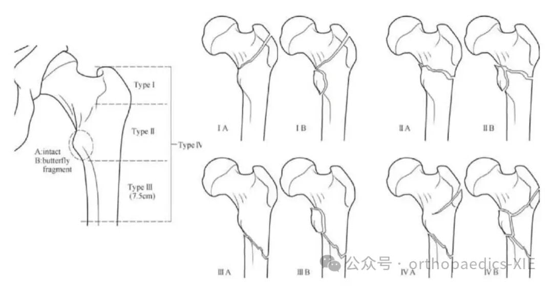 Proximal Femoral Fractures: Classification-Guided Treatment