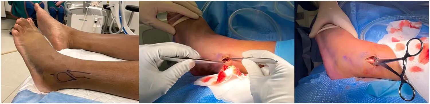 Innovative approach to intramedullary nailing of the fibula: atechnical note