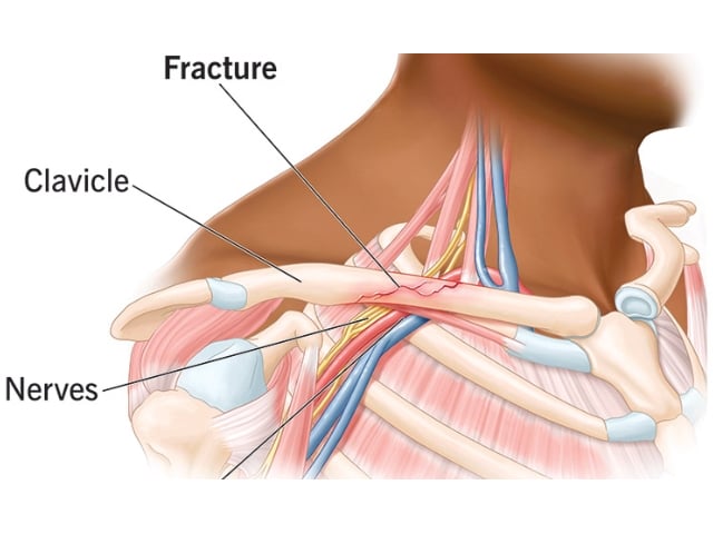 Two Internal Fixation Methods for Clavicle Fractures: Techniques, Tips, and Pitfalls
