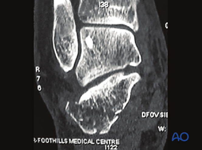 Minimally Invasive K‑Wire and Screw Fixation for Calcaneal Fractures
