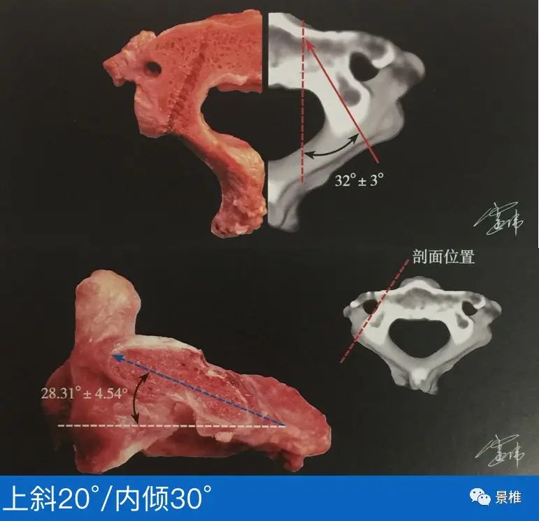 Pedicle Screw Placement Techniques for the Cervical, Thoracic, and Lumbar Spine