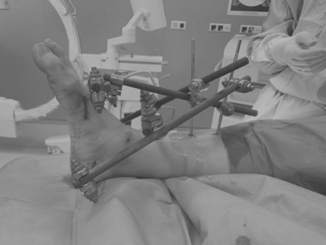 How to Place a First-Stage External Fixator Safely in Pilon Fractures