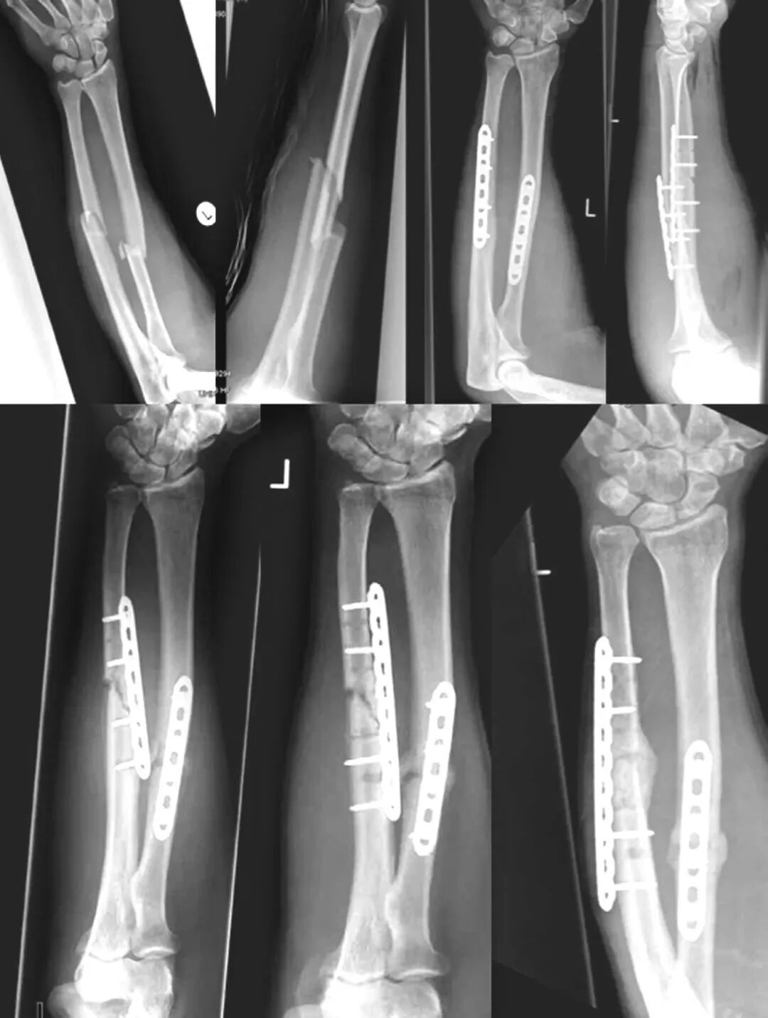 Locking Compression Plate (LCP): Principles and Clinical Applications