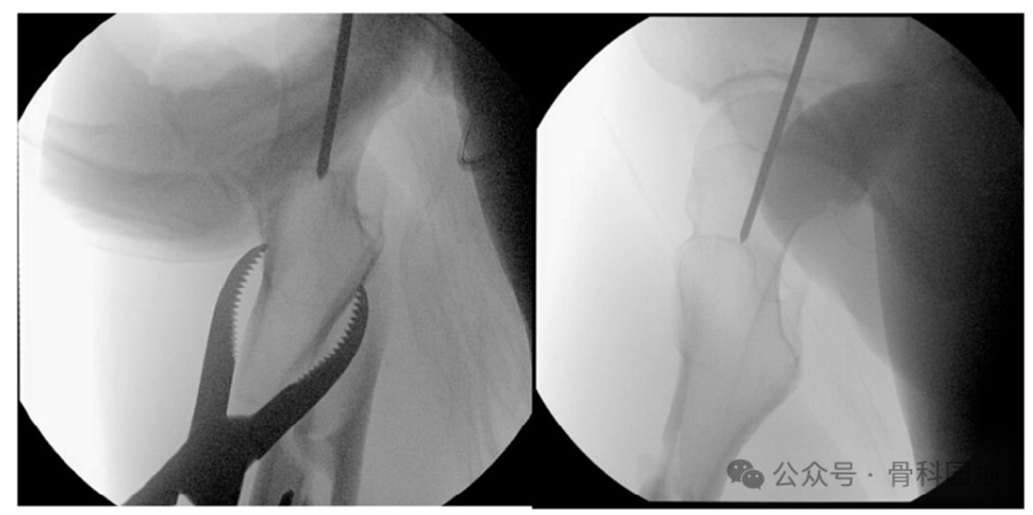Changes in Entry Point for Intramedullary Nailing of Proximal Femoral Fractures: The Central Collinear Method
