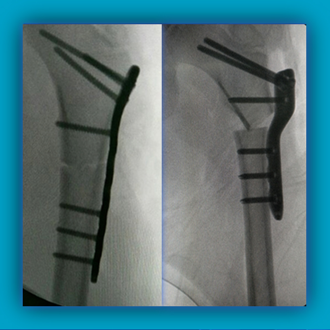 Pediatric Proximal Femoral Osteotomy