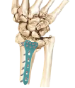 Distal radial volar locking plate: refined design enhances the success rate of fracture fixation