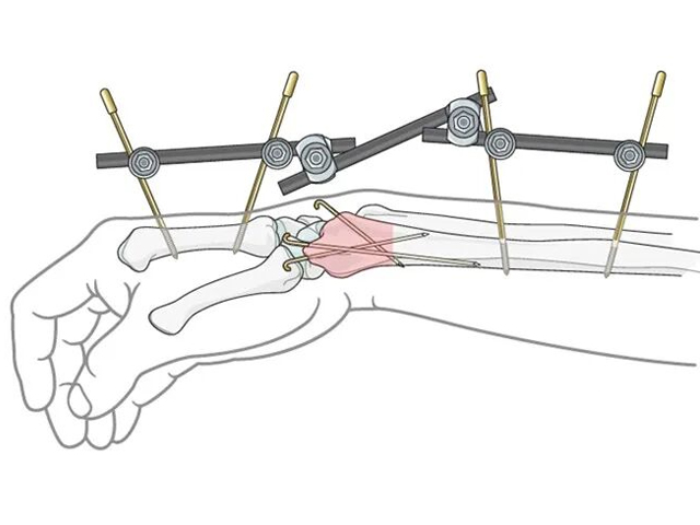 Transarticular External Fixation for Distal Radius Fractures