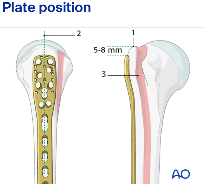 I. Open Reduction and Internal Fixation (ORIF) for Proximal Humeral Fractures