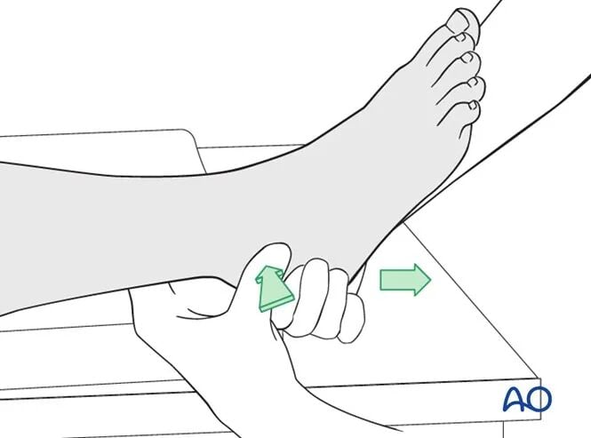 AO Standard Surgery: Screw Fixation for Displaced Talar Neck Fractures