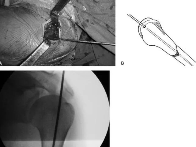Indications and Surgical Techniques for Intramedullary Nailing of Extremity Fractures