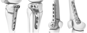 HTO Locking Plate: A Precise and Stable Solution for High Knee Joint Osteotomy