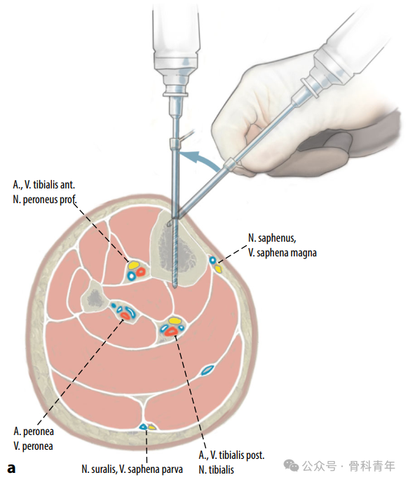 Surgical Steps