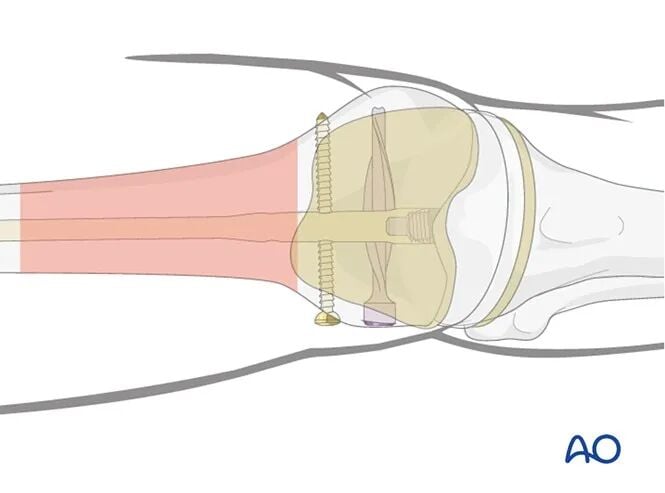 Retrograde Intramedullary Nailing for Periprosthetic Femoral Fractures After TKA: AO Standardized Surgical Strategy – Illustrated Step-by-Step Guide