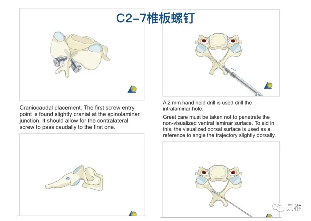 Pedicle Screw Placement Techniques for the Cervical, Thoracic, and Lumbar Spine