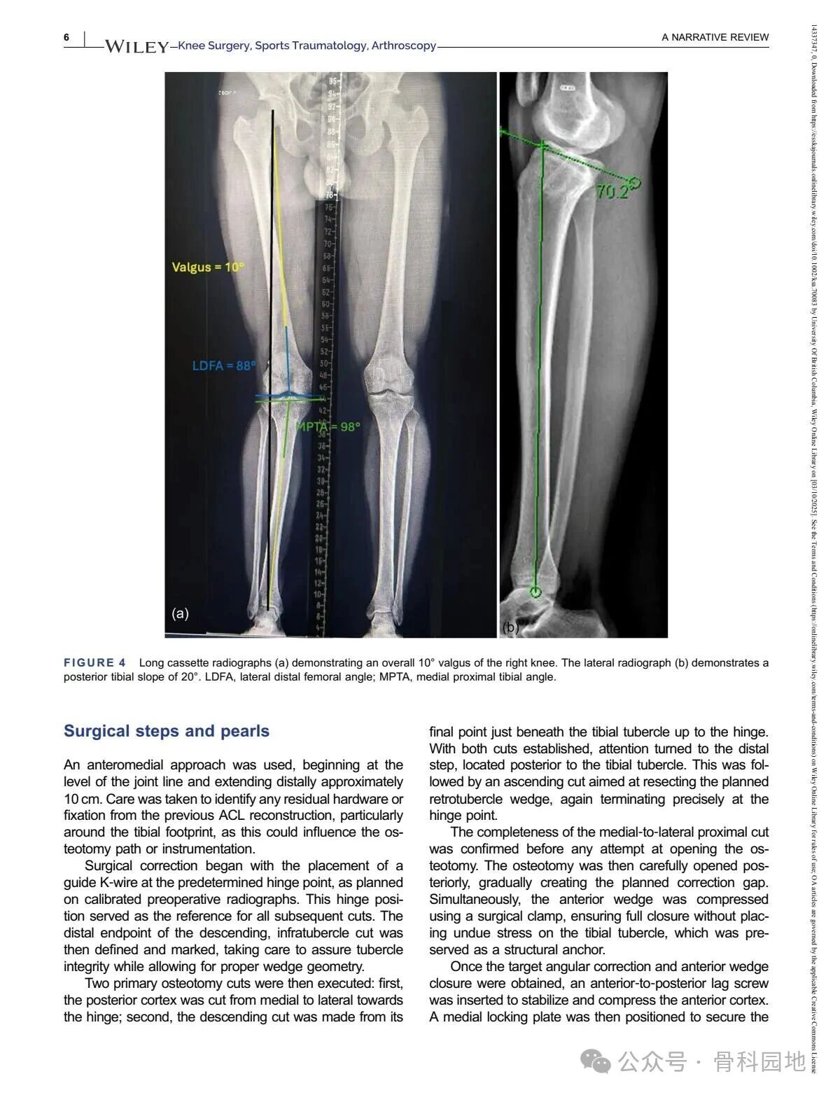 Technical Tips and Tricks for Complex Biplanar High Tibial Osteotomy