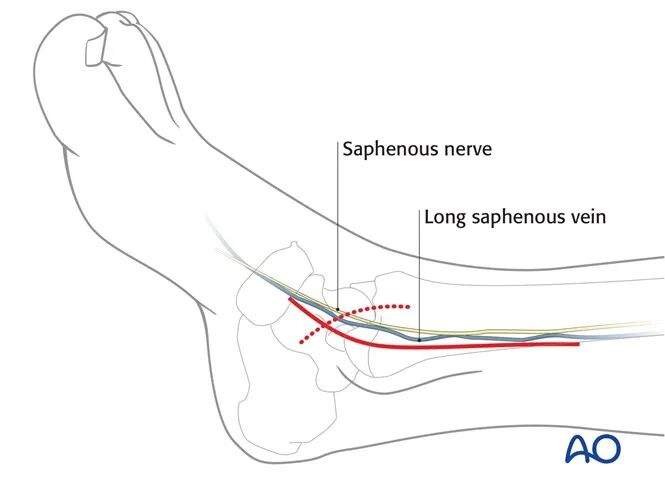 AO Standard Technique: Buttress Plate Fixation for Medial Malleolus Fractures