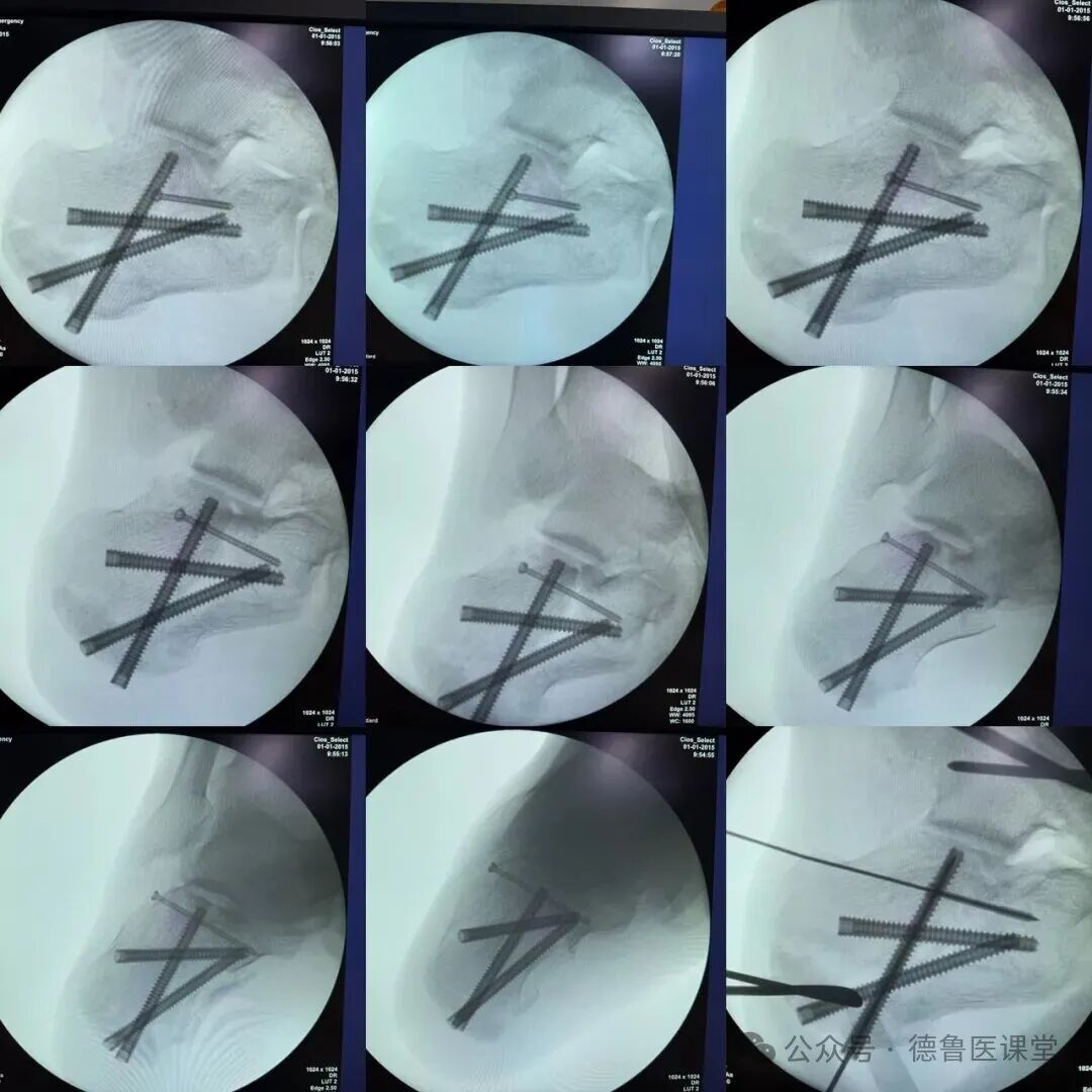 How to Perform a Successful Minimally Invasive Calcaneal Surgery