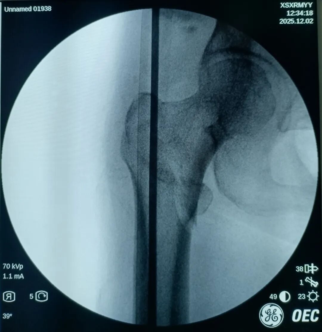 The "Gold Standard Procedure" in Orthopedics: Intramedullary Nailing for Intertrochanteric Fractures – Precise Reduction + Fast Recovery